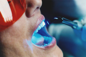 Sbiancamento dei denti laser